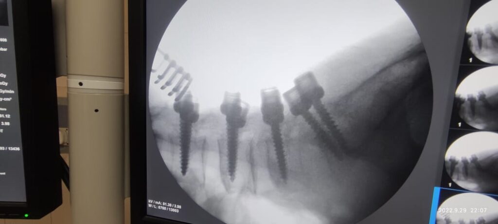 Critical Spine Surgery